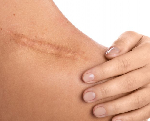 scar discolouration