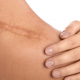 scar discolouration
