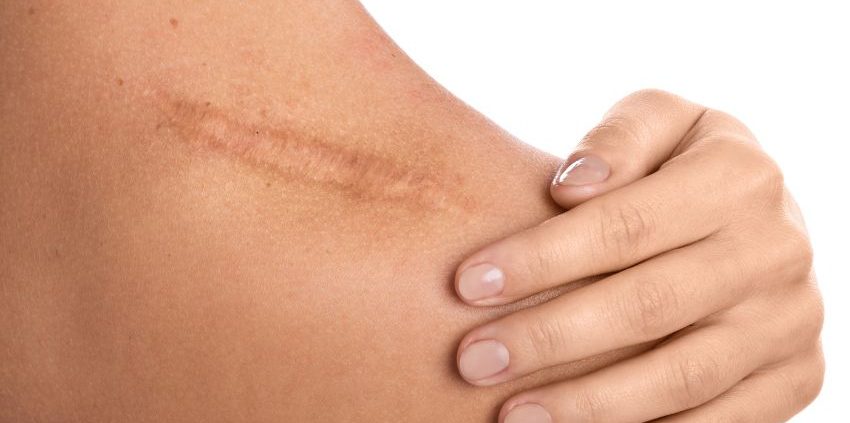 scar discolouration
