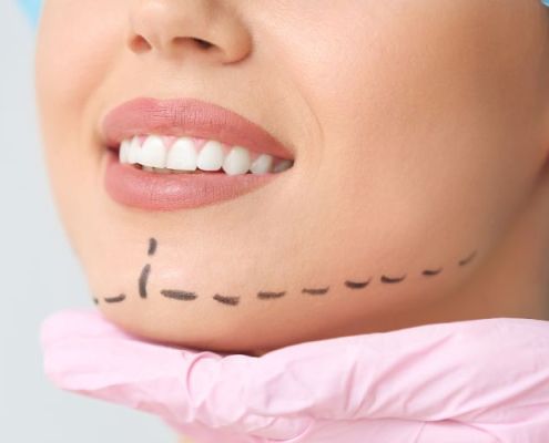 Chin Implants