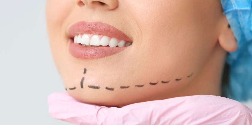 Chin Implants